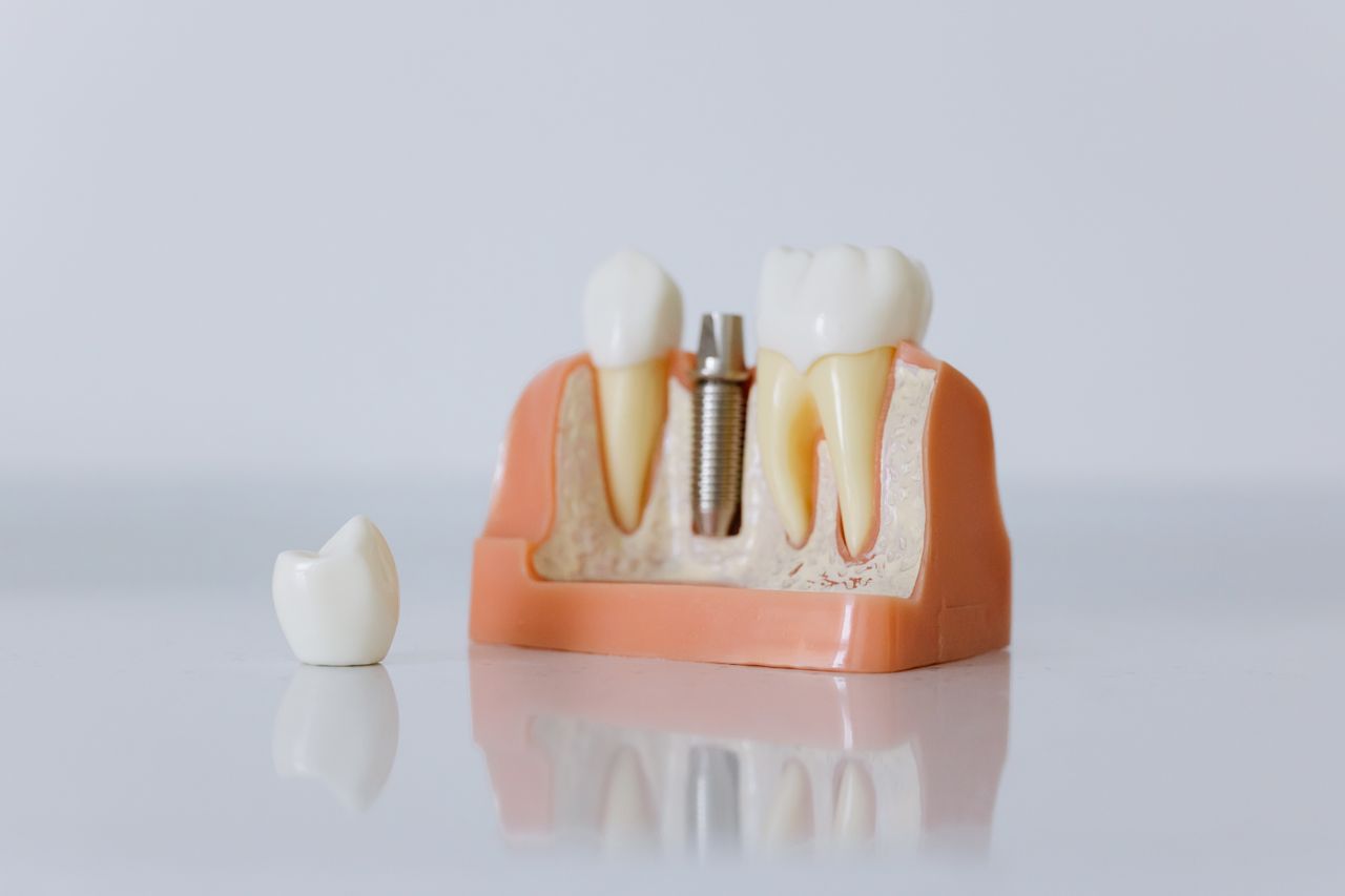 hero-img-02 Close-up of a dental implant model featuring artificial teeth and jaw structure.