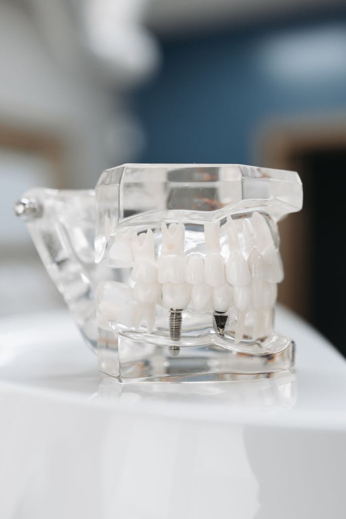 about-01 Transparent dental model showing teeth and implant screws, perfect for educational purposes.
