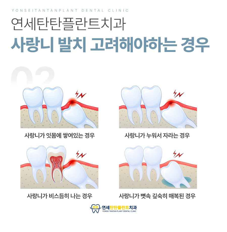의정부사랑니 사랑니 메인이미지 (14)